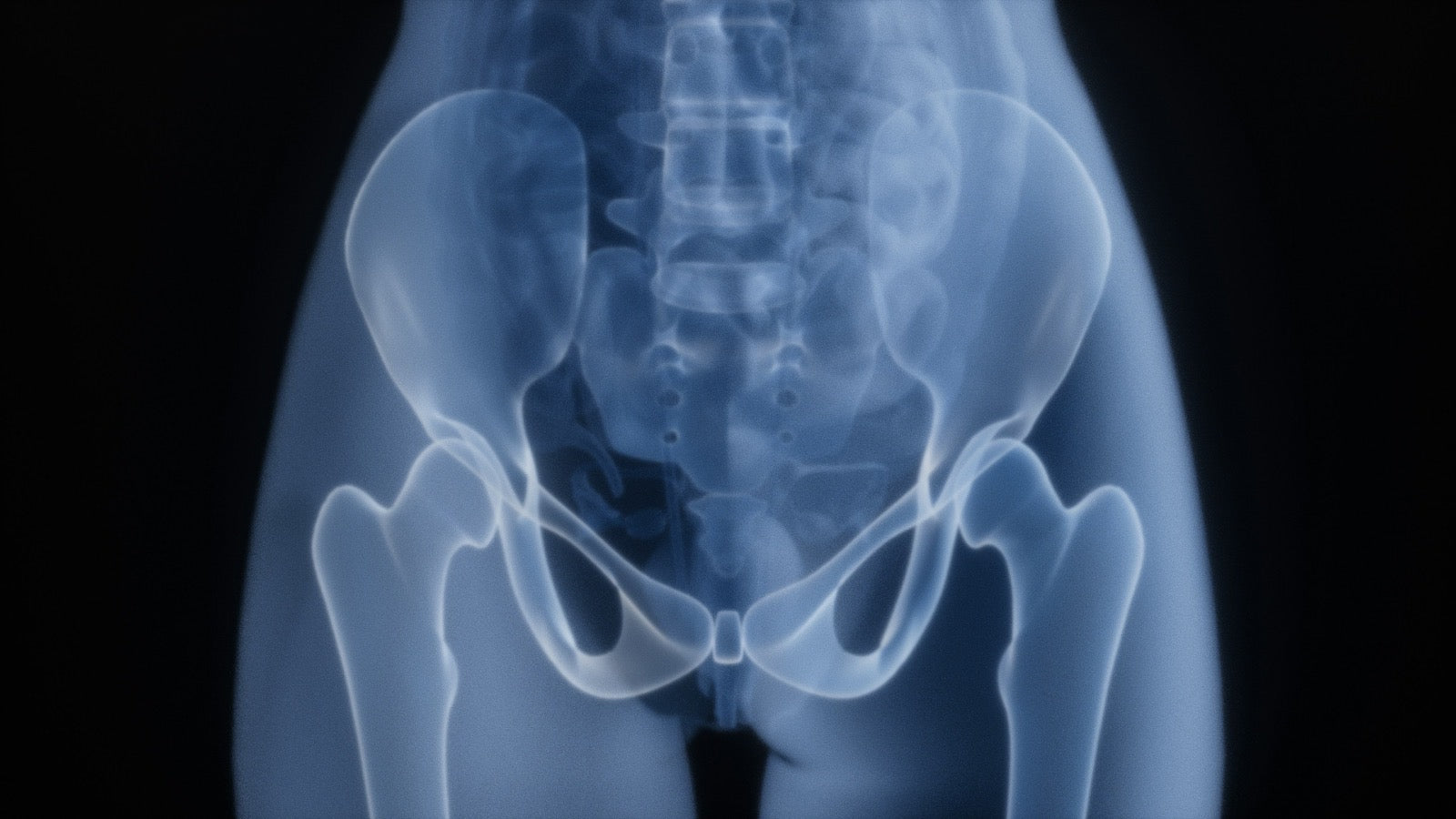 After a hip replacement: milestones for your recovery