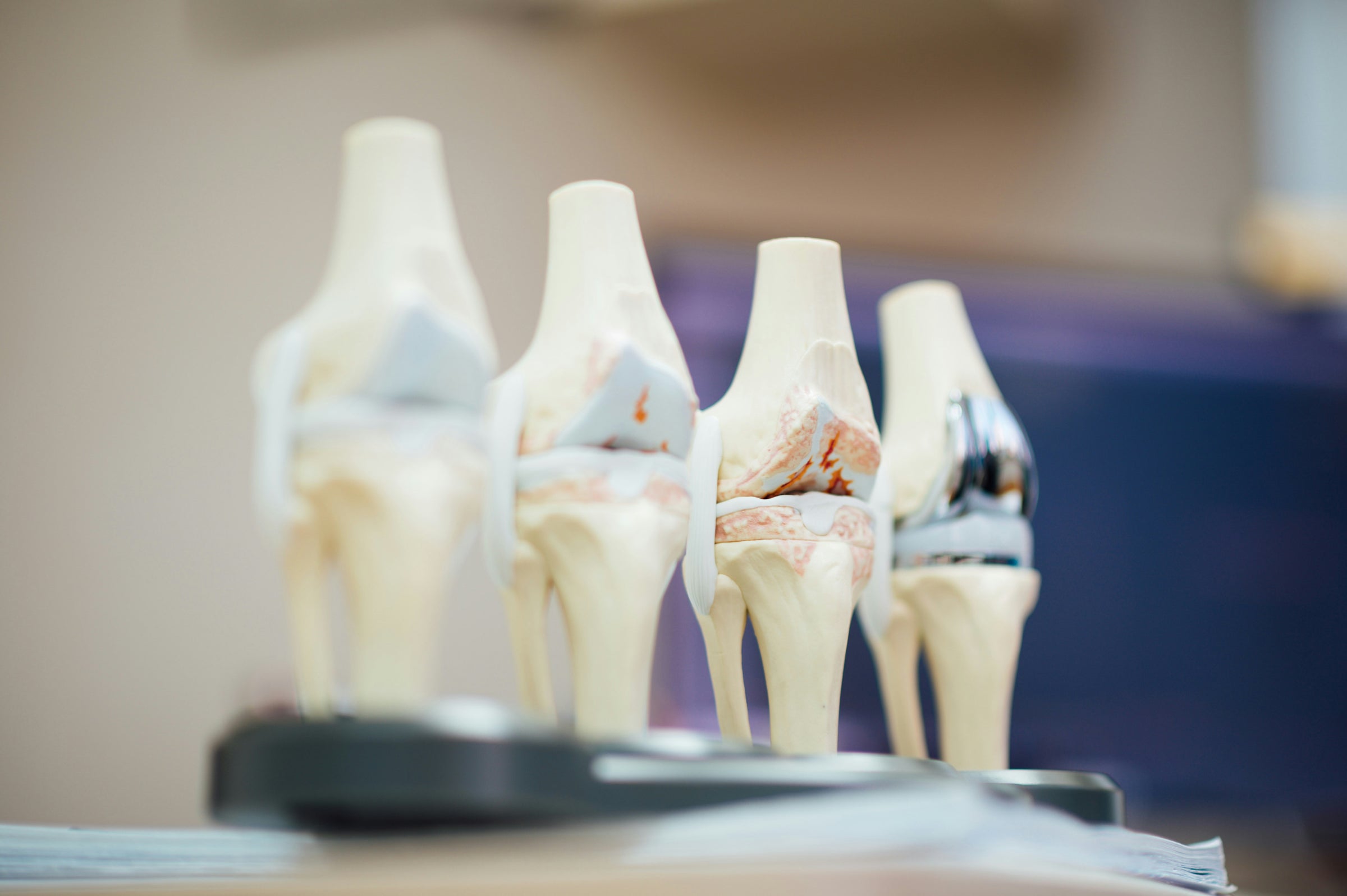 After Knee Replacement: Milestones for Your Recovery